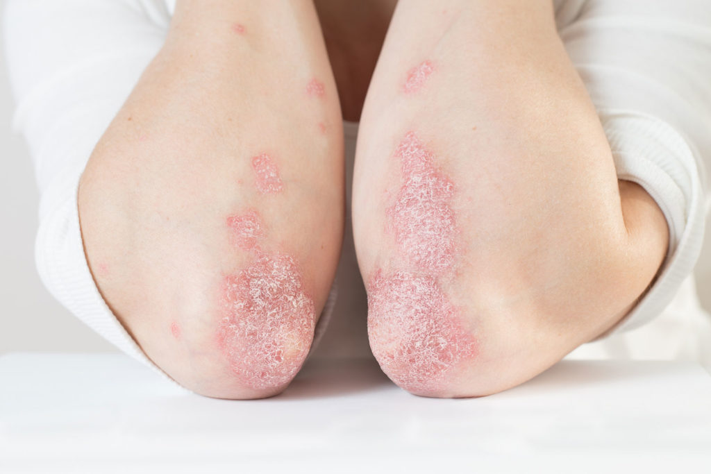 diete-speciale-psoriasis